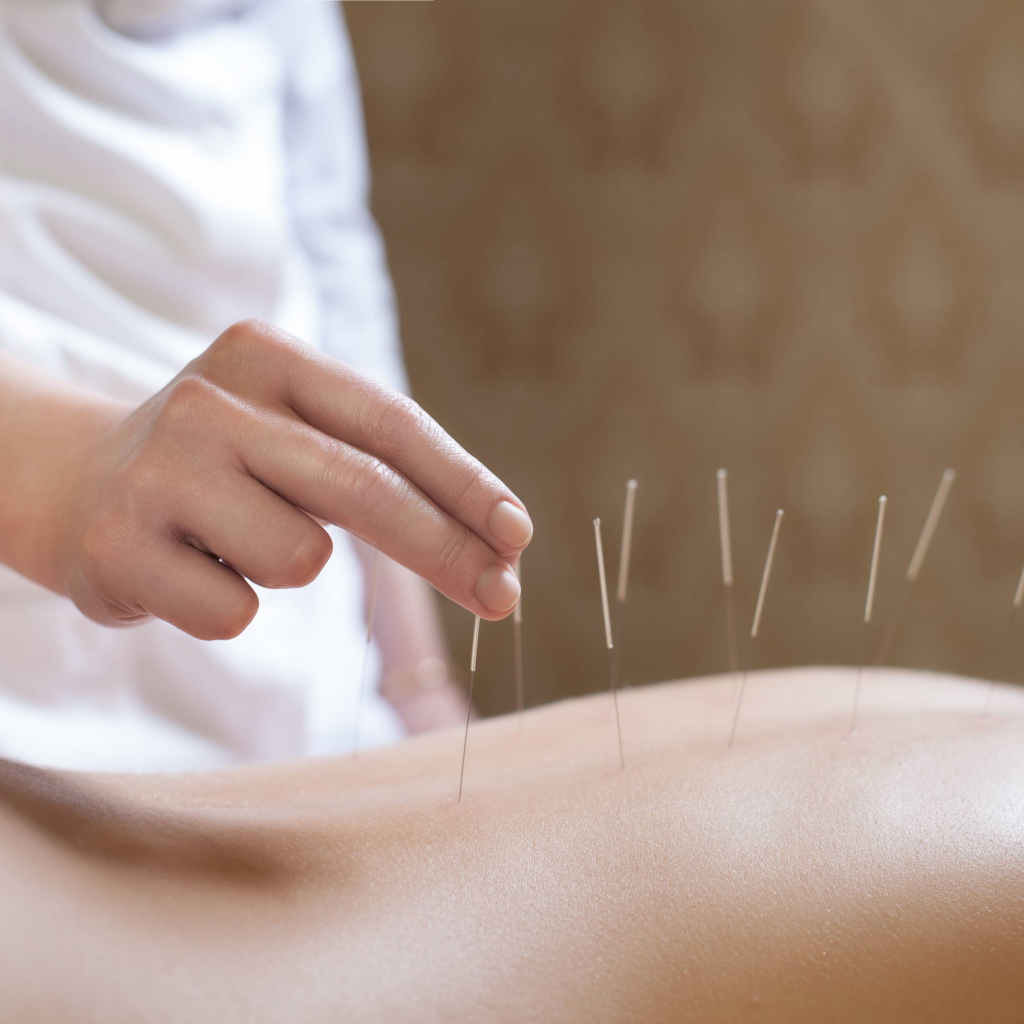 Врач ставит иголки